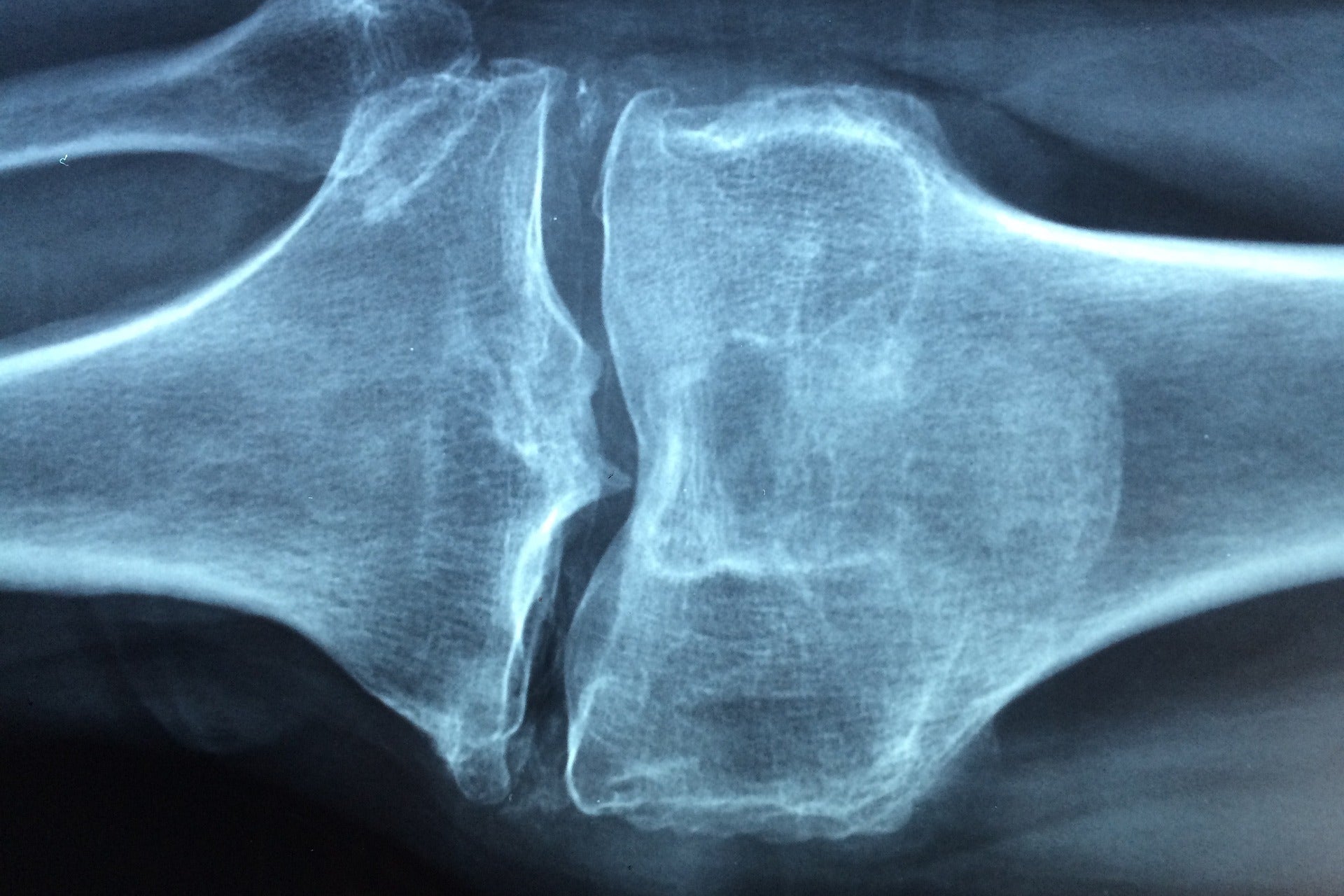 OSTEOPOROSIS & KIT (bone health)
