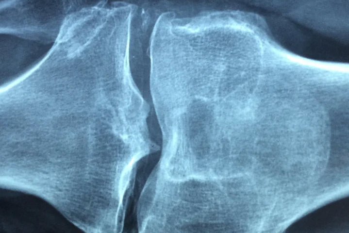 OSTEOPOROSIS & KIT (bone health)