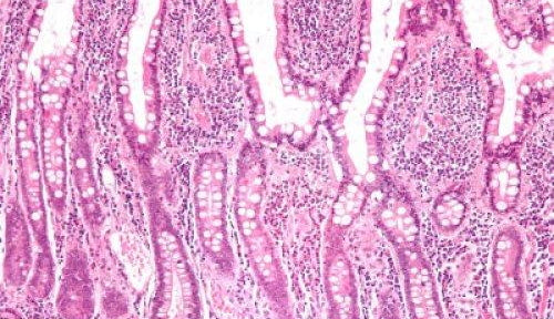 ACNE & THE GUT-BRAIN-SKIN AXIS