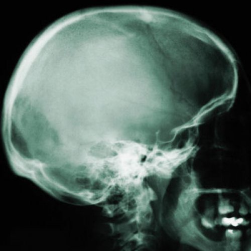 Xray of skull