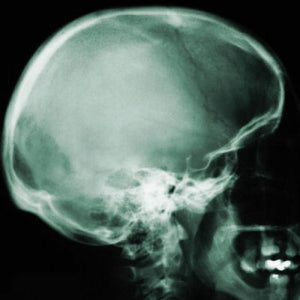Xray of skull