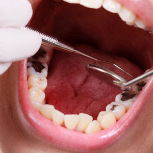 Dental - Caries (DEC)
