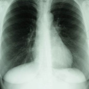 Xray of lungs
