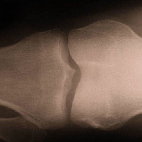 Xray of bone