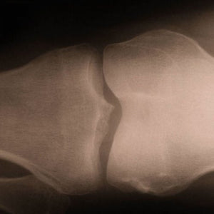 Xray of bone